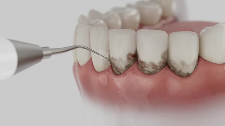 Trusted Wisdom Tooth Removal service in West Point, UT - Dentist Open Now